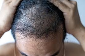 Why Dubai Residents are Turning to Regenera Activa for Hair Restoration