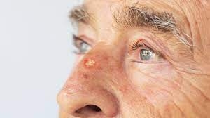 Innovative Approaches to Actinic Keratosis