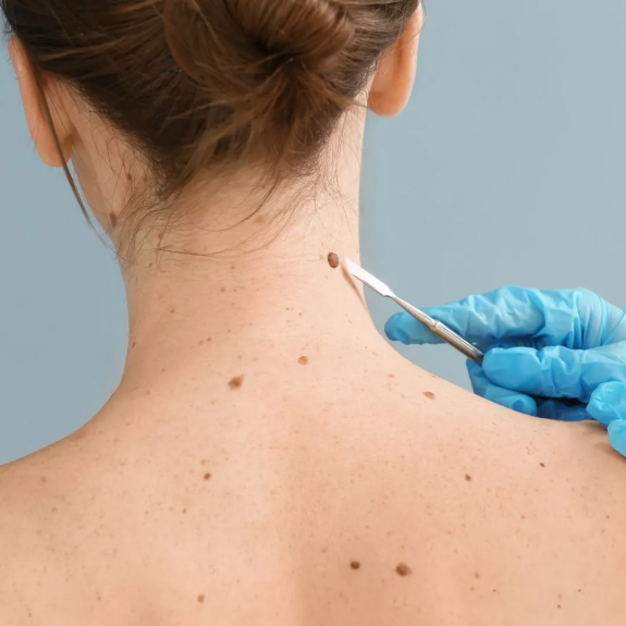 The Art of Seeing: Exploring Dermoscopy in Mole Assessment