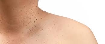 Seborrheic Keratosis: Treatment Options and Procedures