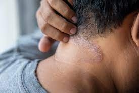 Psoriasis: Identifying and Managing Flare-Ups