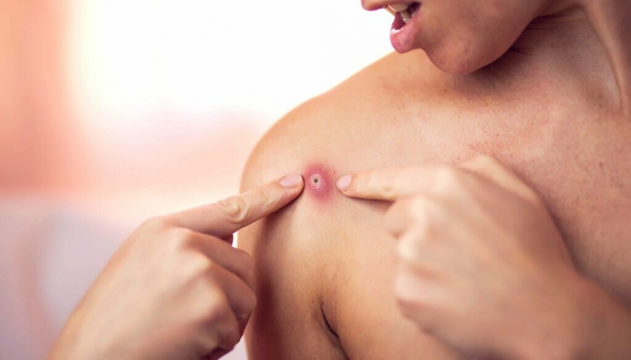 How Abscesses Develop: Pathophysiology Explained