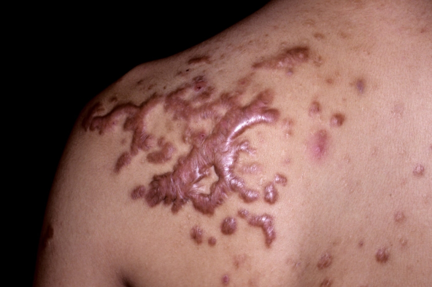 Keloid Scar Management: Latest Medical Advances