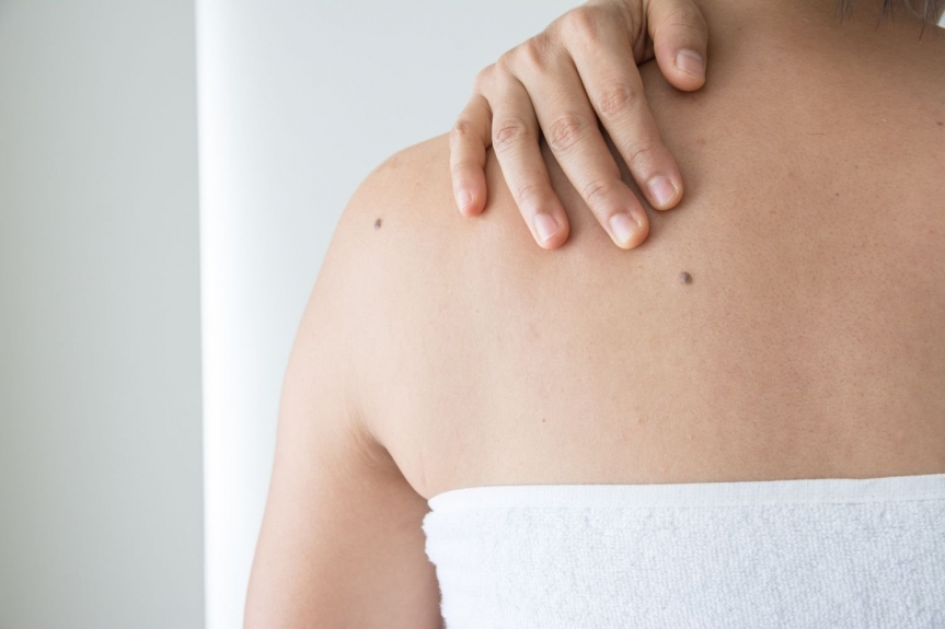Seborrheic Keratosis Treatment Costs in Dubai: What to Expect