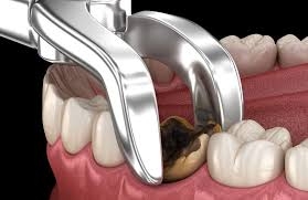 Step-by-Step Tooth Extraction Process in Dubai