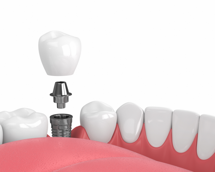 10 Factors Influencing Single Tooth Implant Cost in Dubai