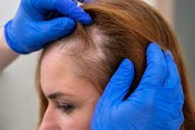 GFC Therapy: Revolutionizing Hair Loss Treatment in Dubai