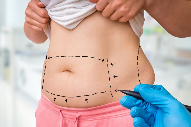 VASER 4D Liposuction in Dubai: Precision Body Sculpting