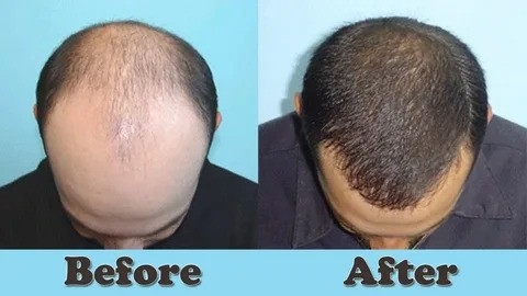 Comprehensive Guide to Hair Scalp Treatment and Hair Transplant in Singapore