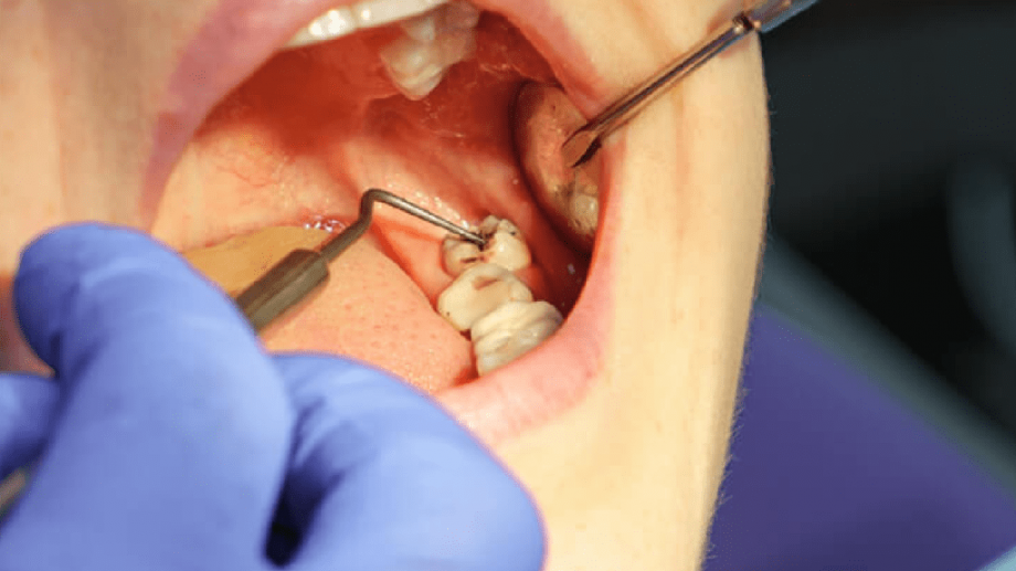 Exploring Affordable Options for Wisdom Tooth Extraction in Dubai