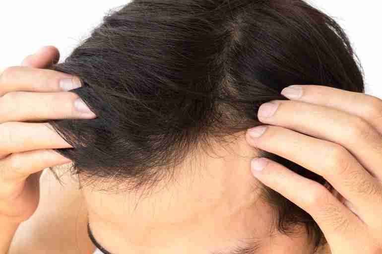 Harnessing the Power of Finasteride for Hair Loss in Dubai