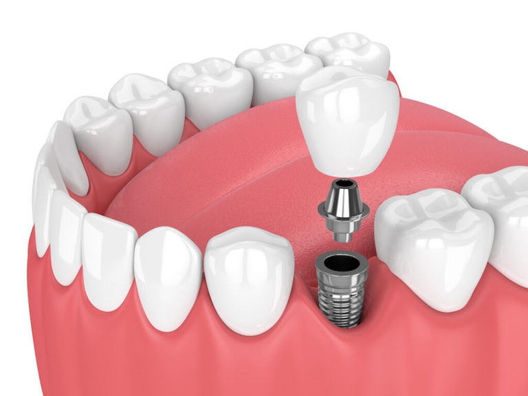 Are Single Tooth Implants in Dubai Permanent?