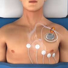 Pacemaker Cost in Delhi Understanding Your Options and Choosing the Right Care