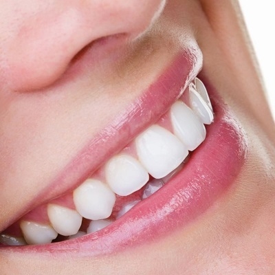 Teeth Whitening in Dubai: Achieving a Natural-Looking Smile