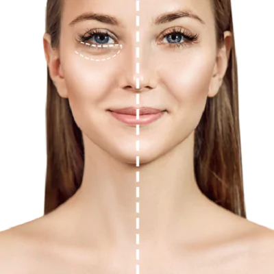 Transform Your Appearance with Dark Circles Treatment in Dubai