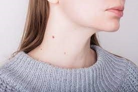 Skin Tag Removal for Sensitive Skin in Dubai: A Comprehensive Guide