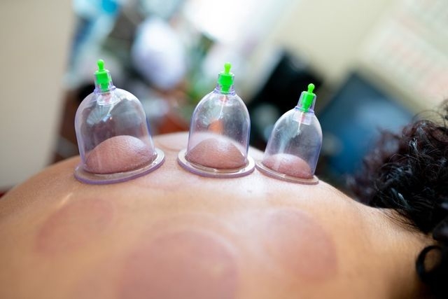 How to Budget for Hijama Treatment in Dubai