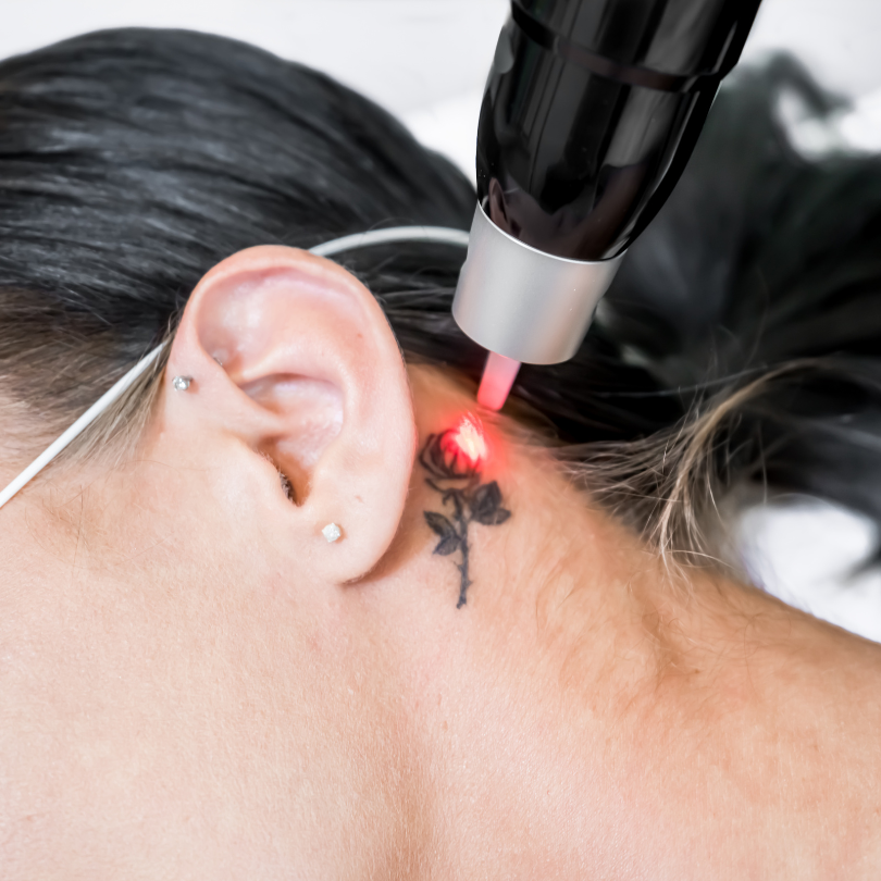 Understanding the Duration of Laser Tattoo Removal Sessions in Dubai