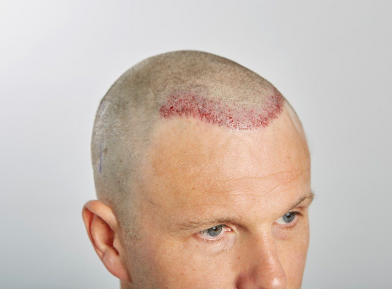 FUE Hair Transplant Recovery: Managing Expectations in Dubai