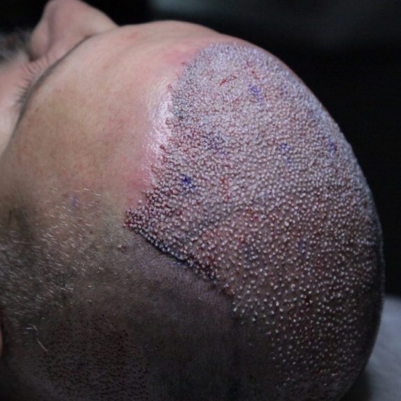 FUE Hair Transplant in Dubai: Expert Consultations