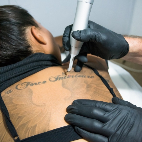 Laser Tattoo Removal: Innovations and Advances in Dubai