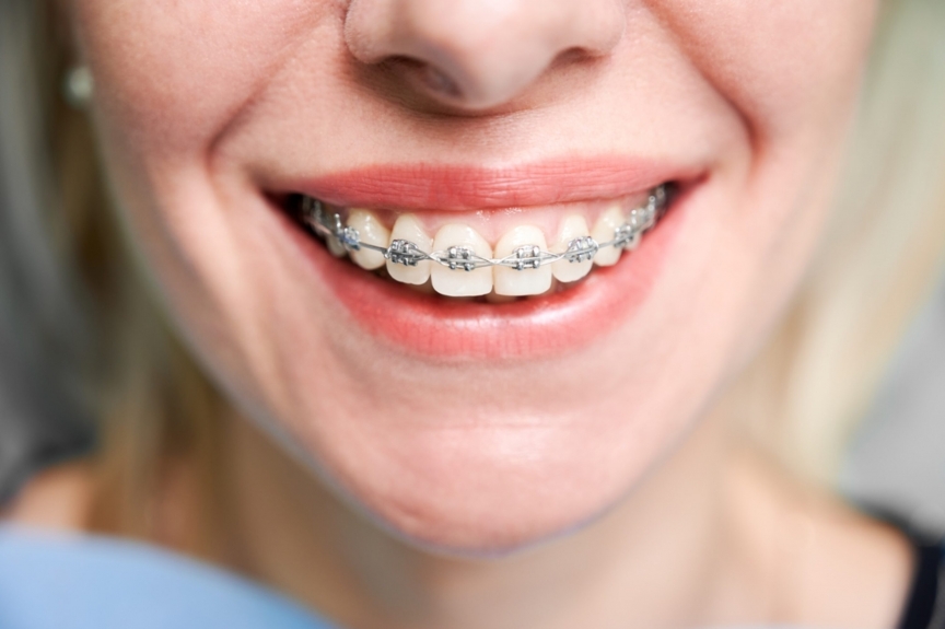 What Should I Consider When Budgeting for Braces in Dubai