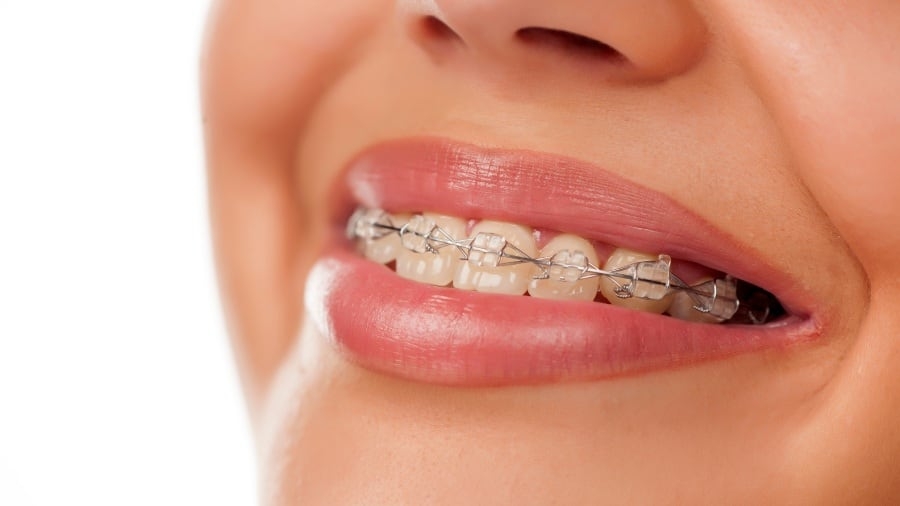 Dental Braces and Their Effects on Social Life in Dubai
