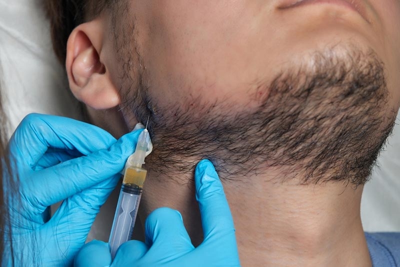 The Effectiveness of Beard Hair Transplants: Insights from Dubai