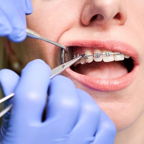 Top Choices for Inexpensive Dental Braces in Dubai