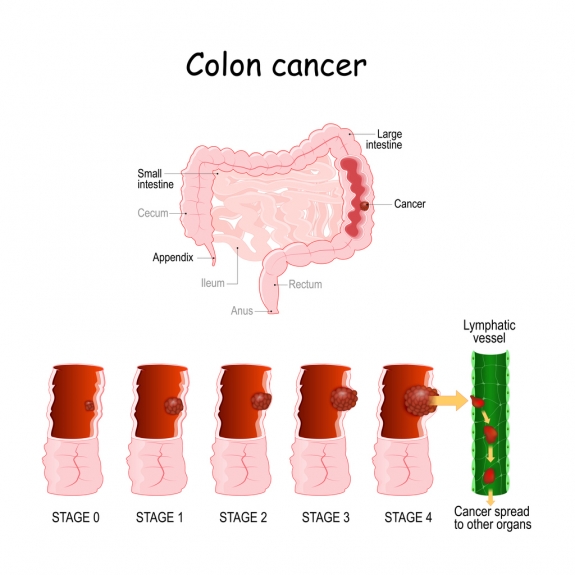 Early Signs of Colon Cancer: When to Consult the Best Colorectal Surgeon in Surat