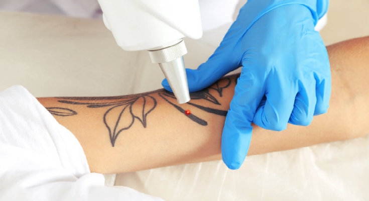 Picosure Tattoo Removal in Dubai: Safe, Fast, and Perfect for Your Skin Type