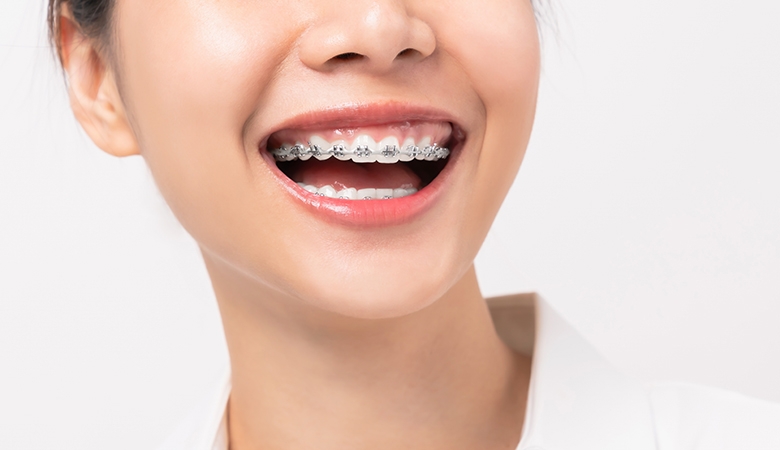 Dental Braces in Dubai: Enhancing Smiles and Oral Health