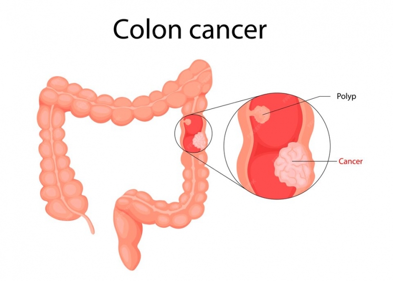 9 Things You Should Know About Colon Cancer