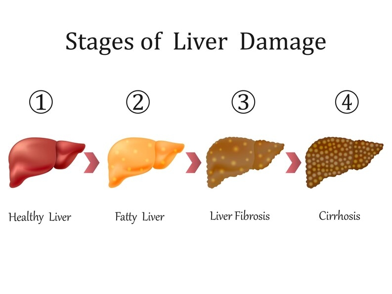 Fatty Liver Disease: What You Need to Know from a Trusted Gastrosurgeon