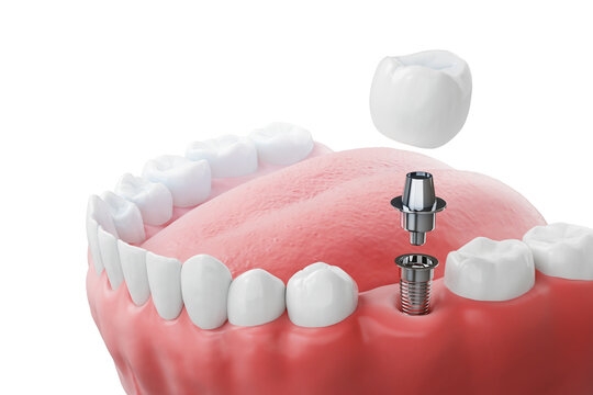 How Single Tooth Implants in Dubai Can Improve Your Smile