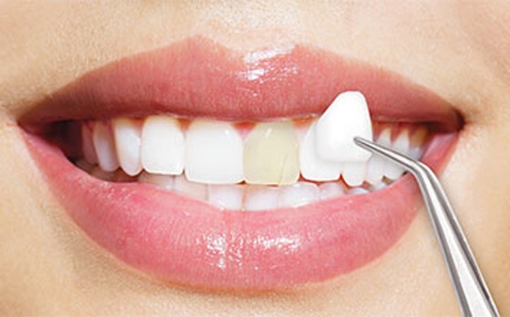 What Is the Cost of the Best Veneers in Dubai?