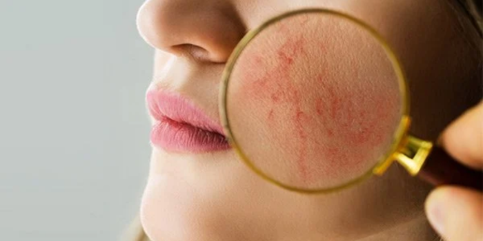 Can Laser Treatments Reduce Pigmentation Issues?    