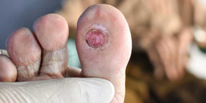 Diabetic Foot Treatment in Greater Kailash: Gentle Care for Your Feet