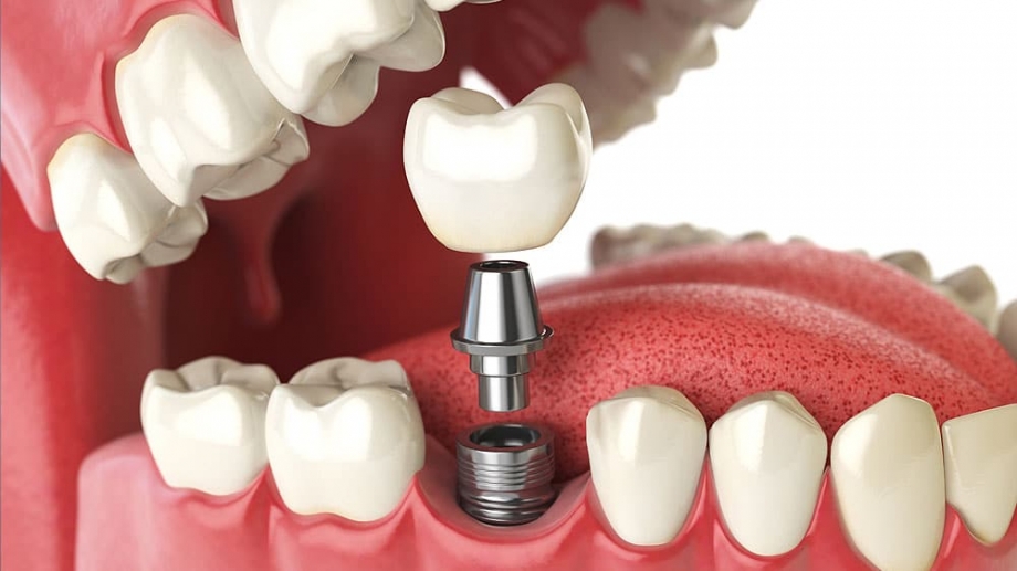 Explore Cost-Effective Single Tooth Implant Solutions in Dubai