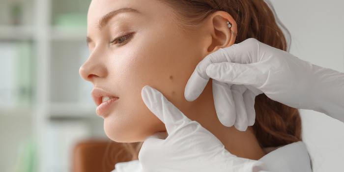 8 Tips for Choosing the Right Mole Removal Clinic