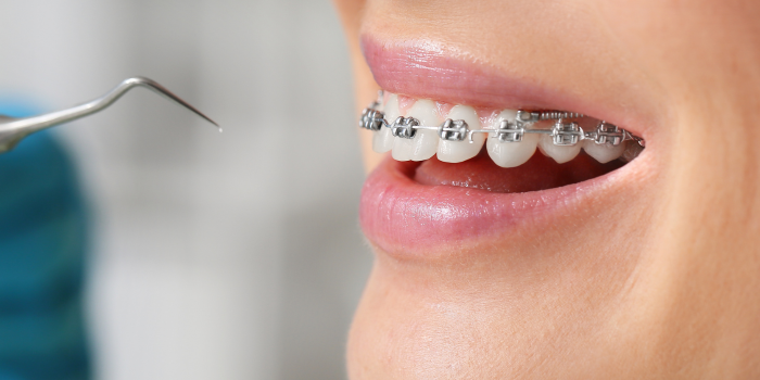 Braces Treatment in Gurgaon: A Caring Approach to Transforming Your Smile
