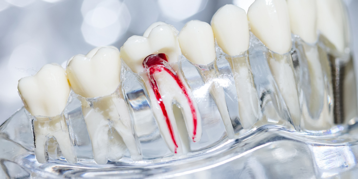 The Essential Guide to Understanding Root Canal Treatment
