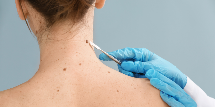 Mole Removal for Different Skin Types: What You Need to Know?