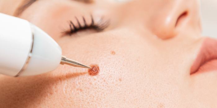 8 Common Myths about Wart Removal Treatment