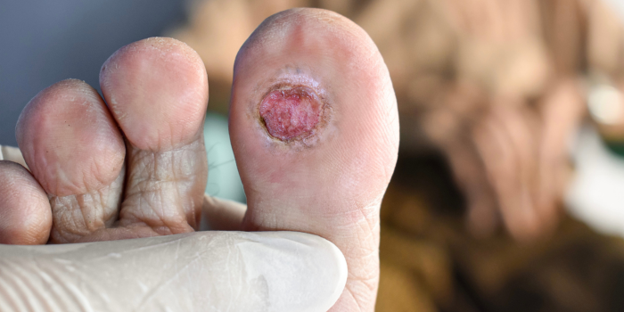 Where Compassion Meets Expertise: Diabetic Foot Treatment in Greater Kailash