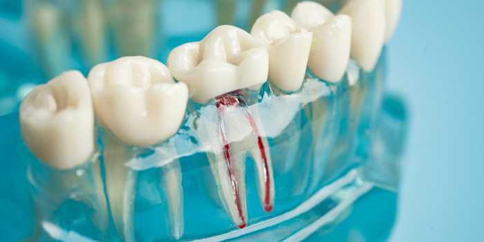 Why Root Canal Treatment in Gurgaon Is a Reliable Solution for Dental Pain