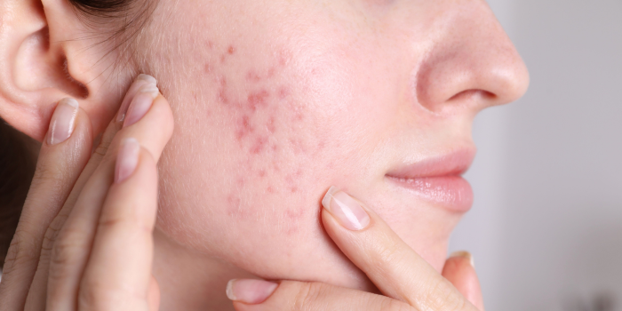 What causes acne, and how do I treat it?