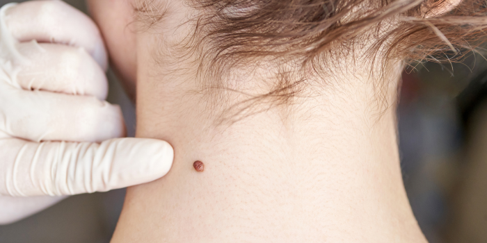 When Should You See a Dermatologist for Wart Removal?