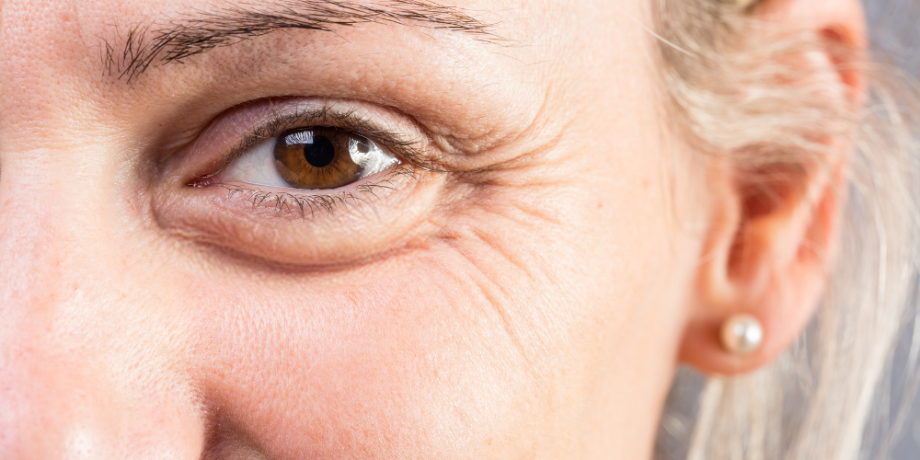 How To Get Rid Of Crow’s Feet Without Injections?