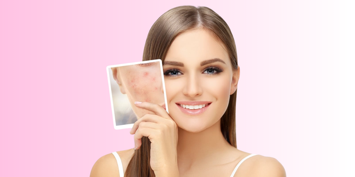 5 Recommended Derma Treatments for Acne Scar Removal